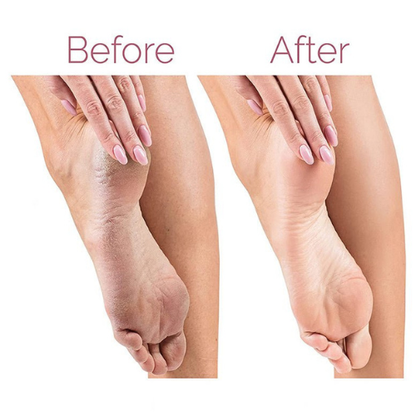 Electric Pedicure Foot File Callus Remover